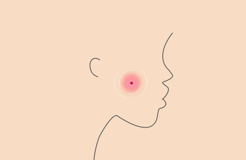 3 Food Types That Cause Acne to Avoid