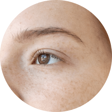Hyperpigmentation