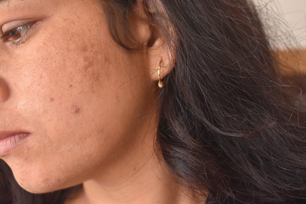 Image of Does Glycolic Acid Work For Dark Spots?