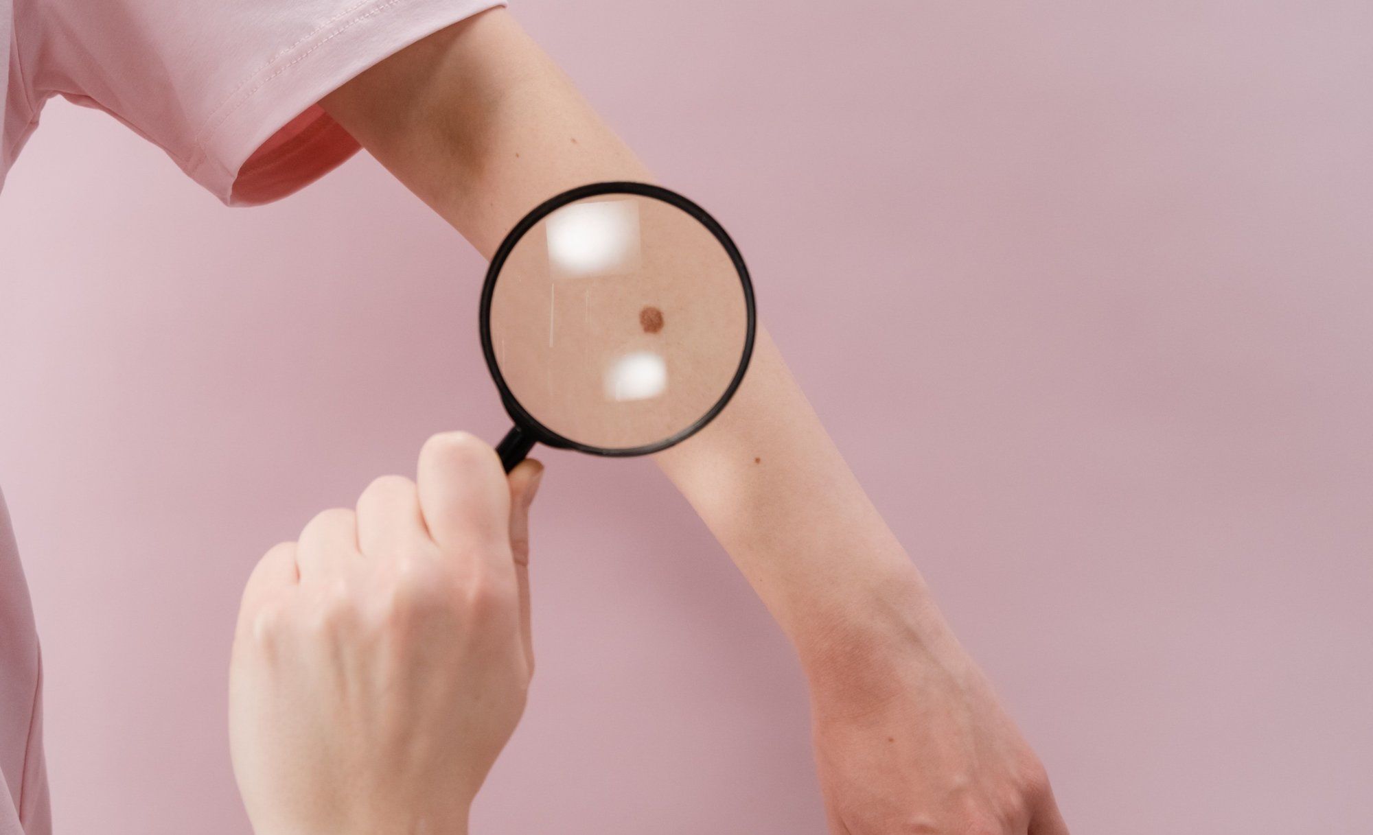 Image of How To Get Rid Of Moles On Skin: Is It Safe?