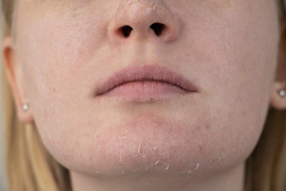 Image of Your Ultimate Guide to Dry Skin in Summer Months