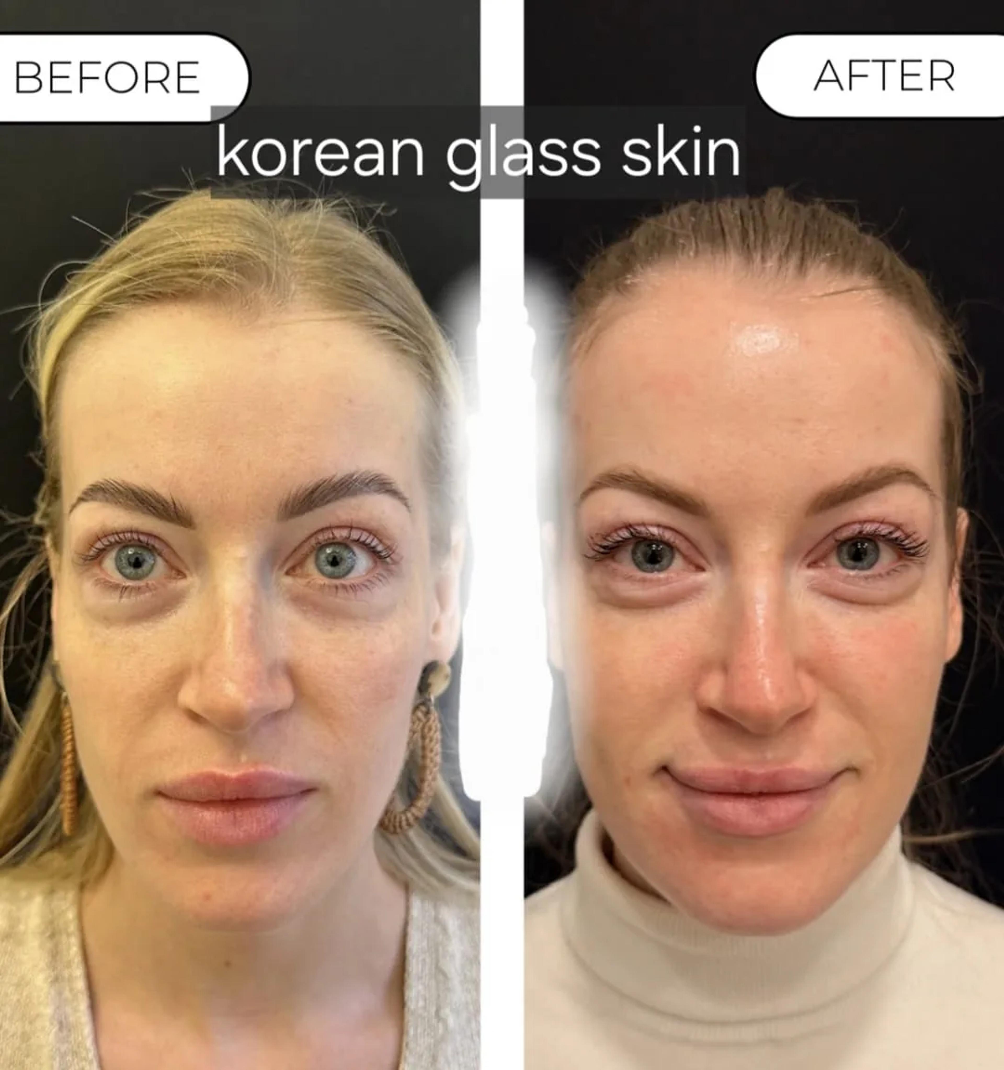 Korean glass skin: voor en na