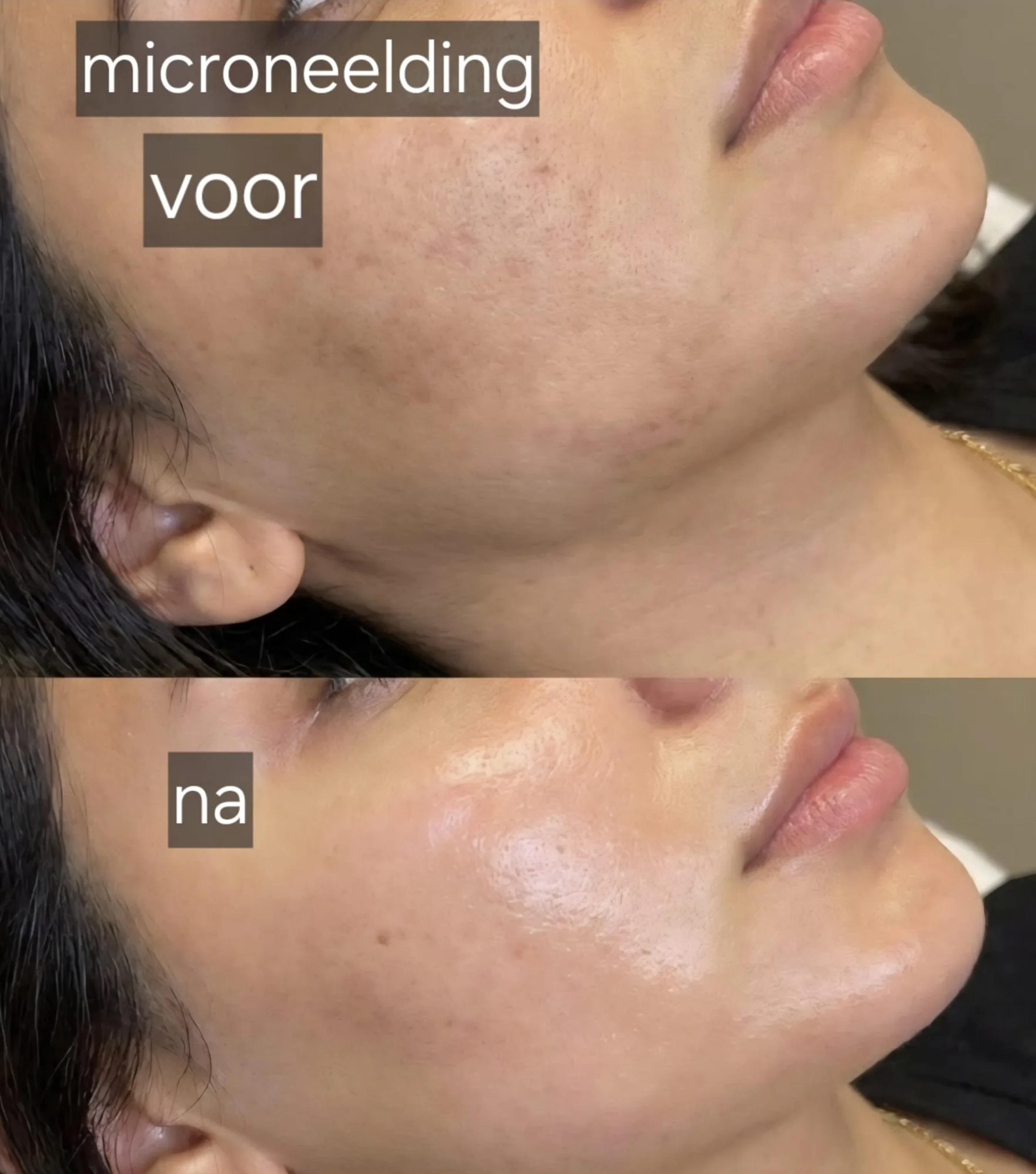 Microneedling: voor en na