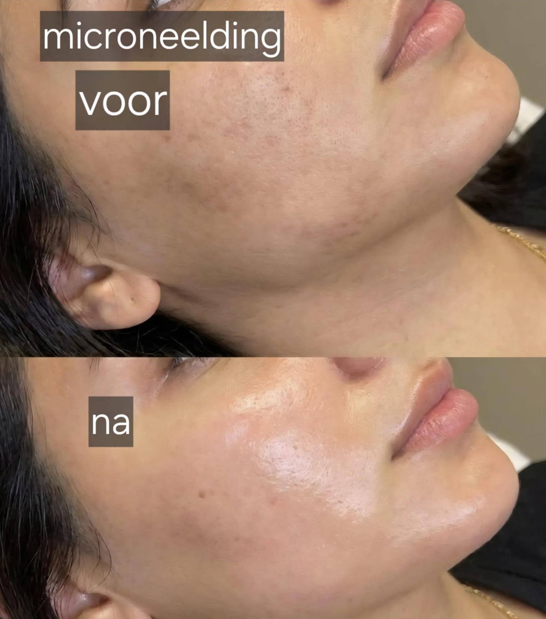 Microneedling: voor en na