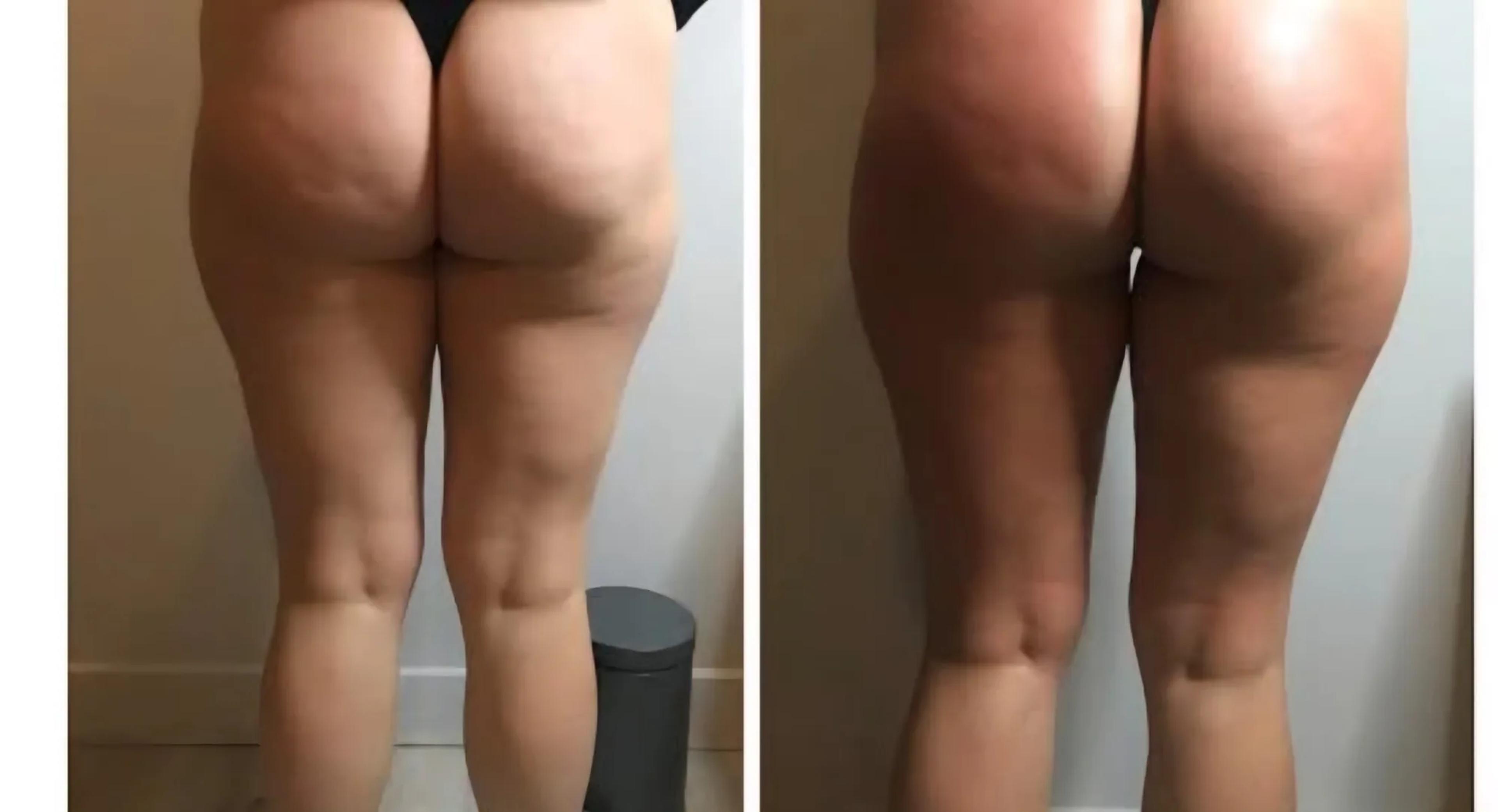 Bindweefselmassage: voor en na