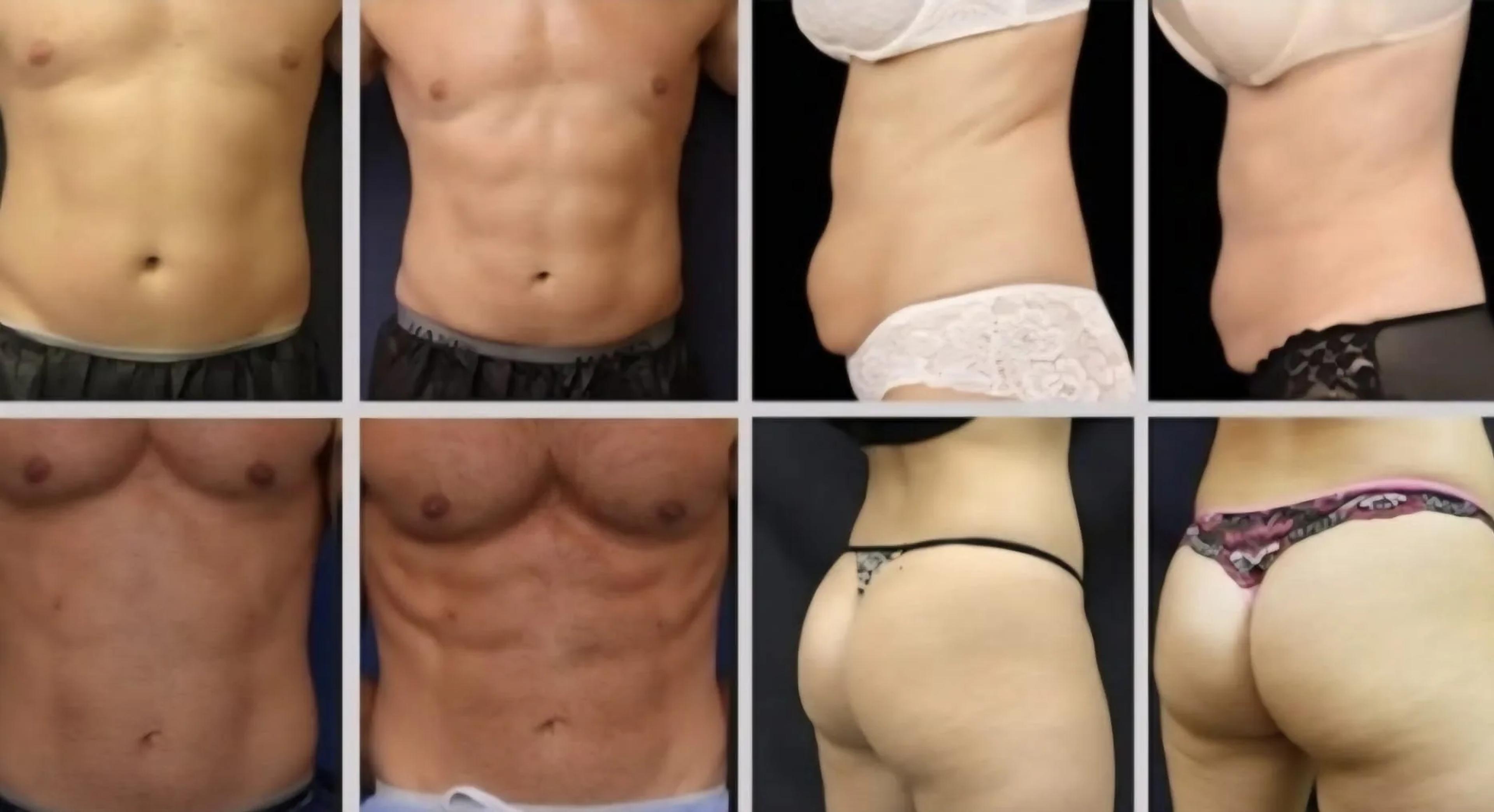 EMS sculpting: voor en na