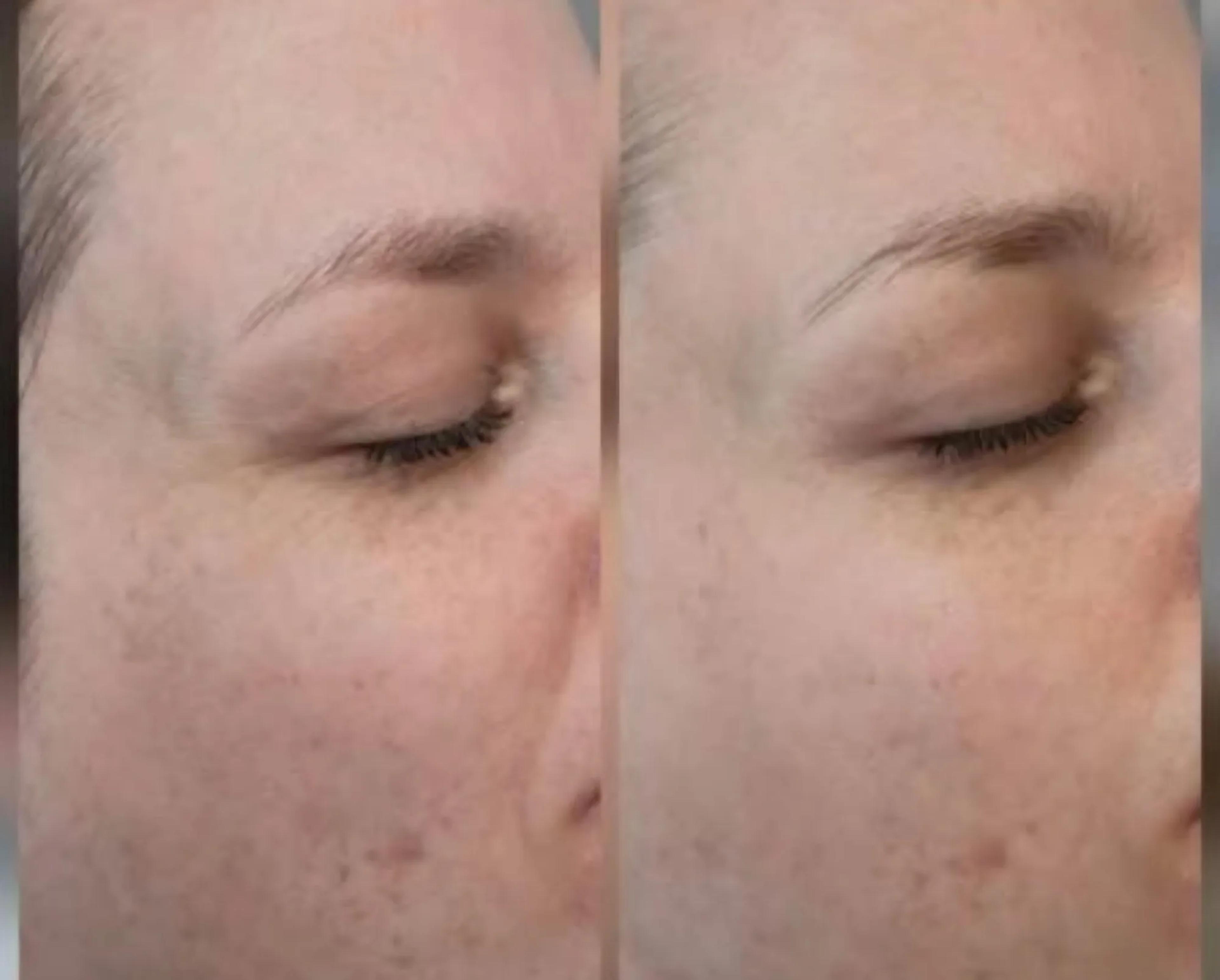 Dermabrasie: voor en na