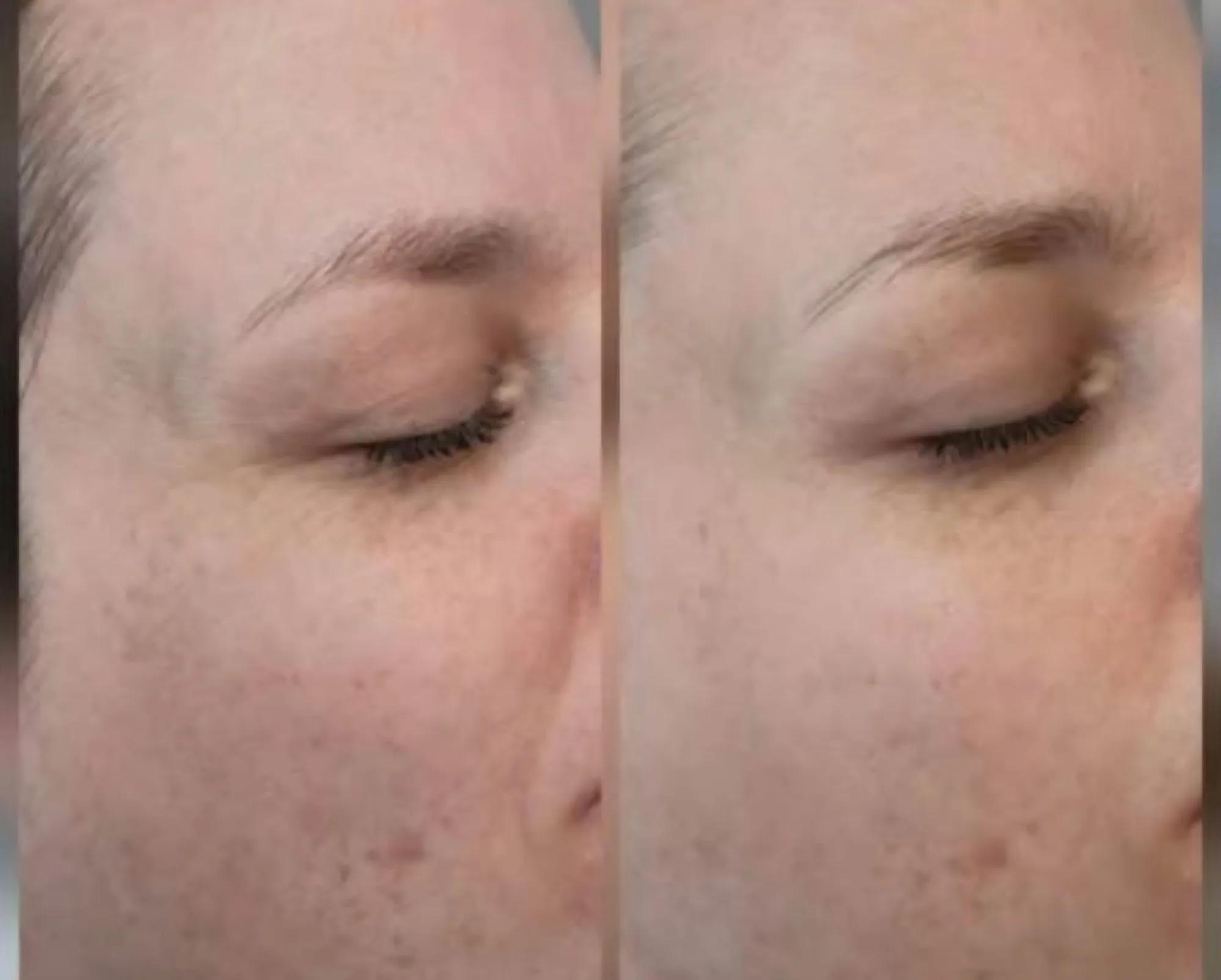 Dermabrasie: voor en na