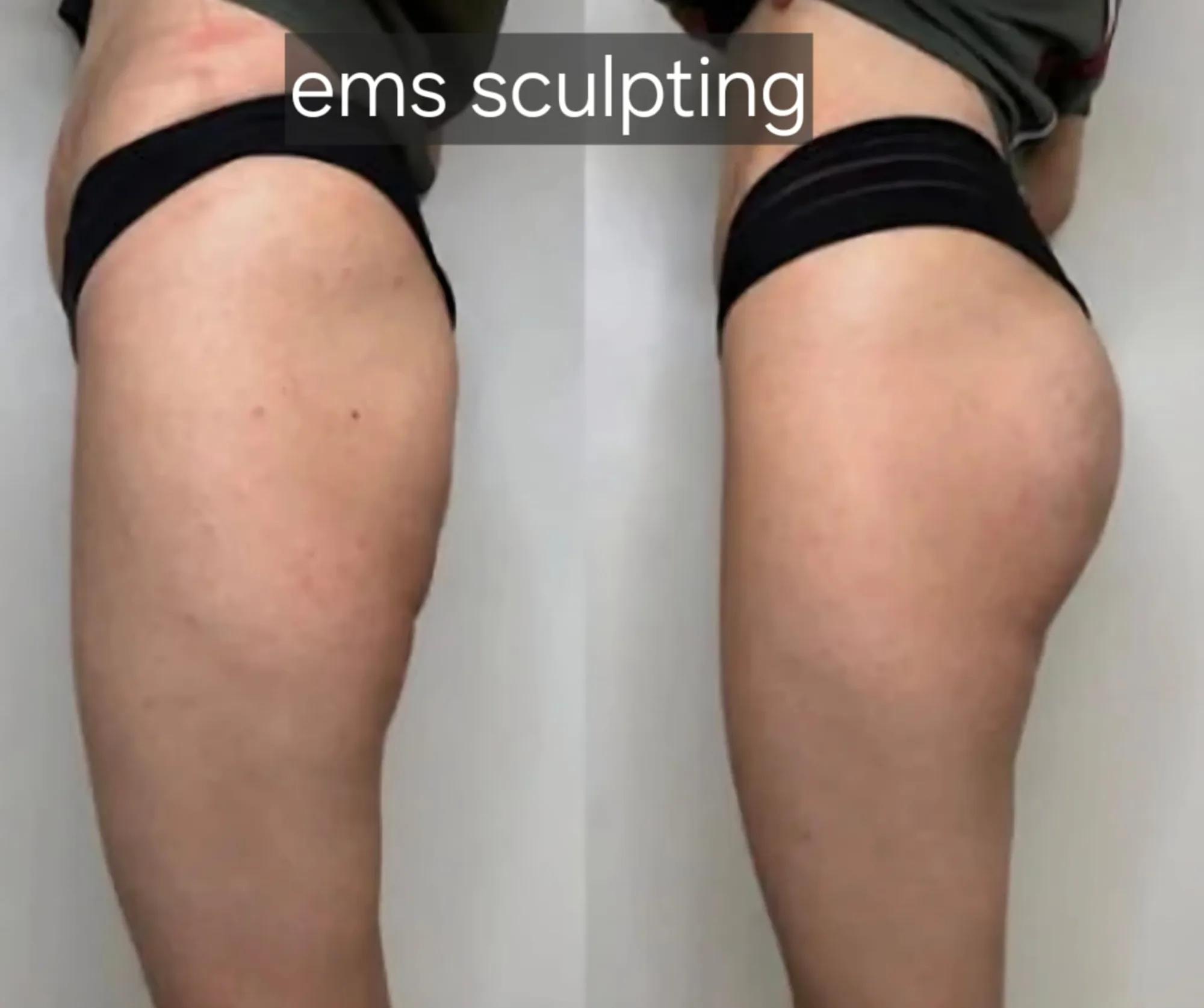 EMS sculpting: voor en na
