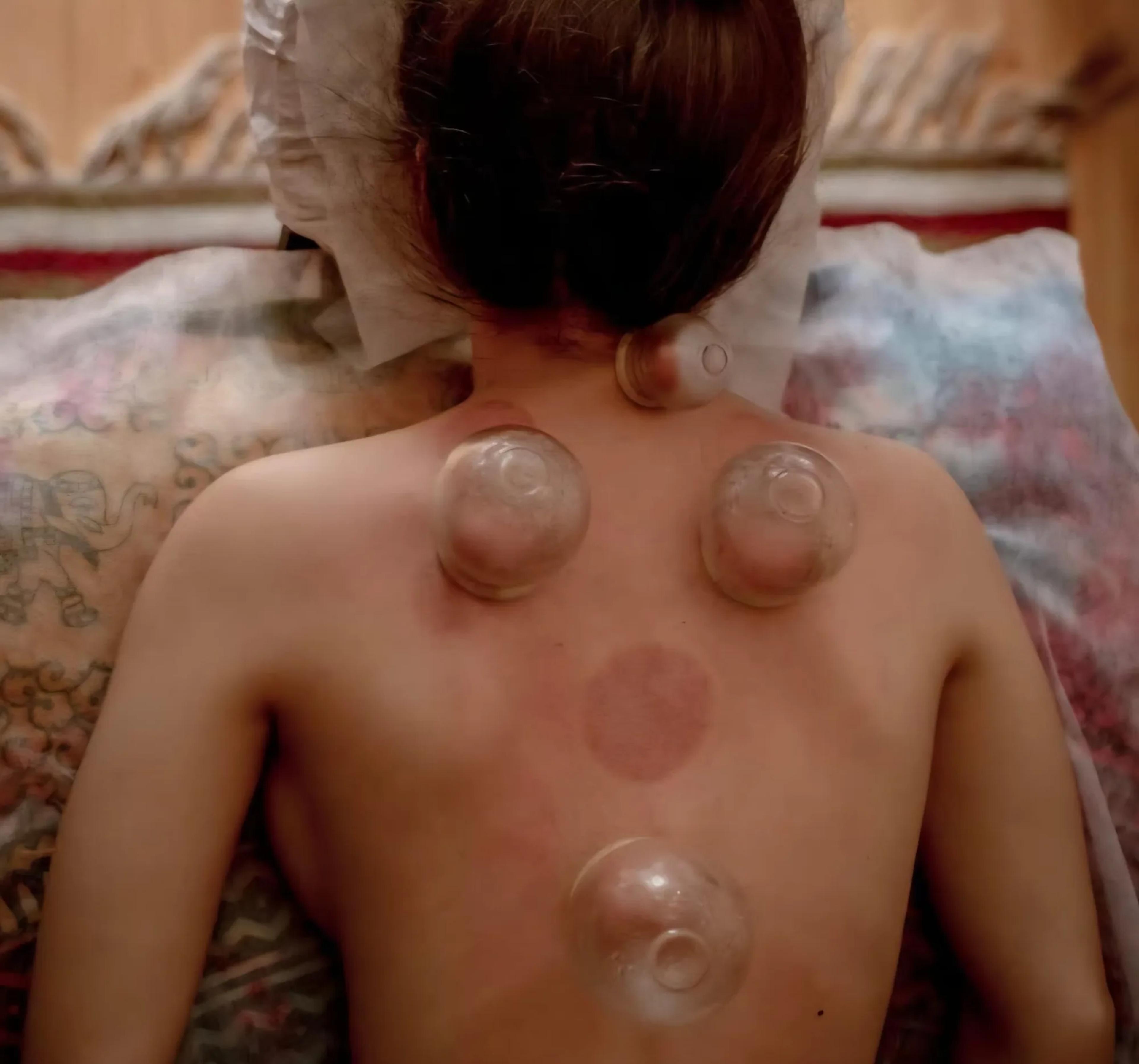 Cupping massage