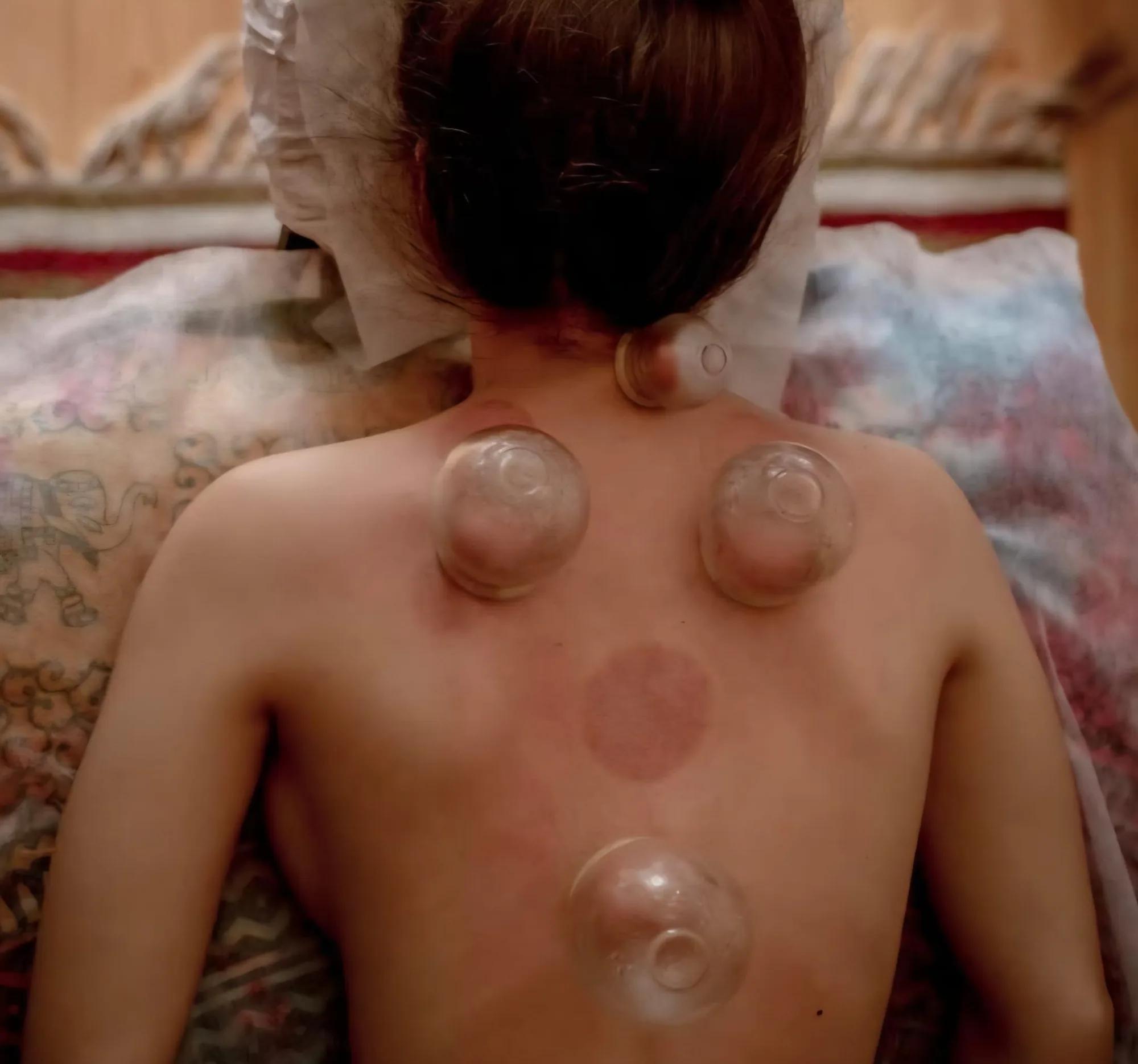 Cupping massage