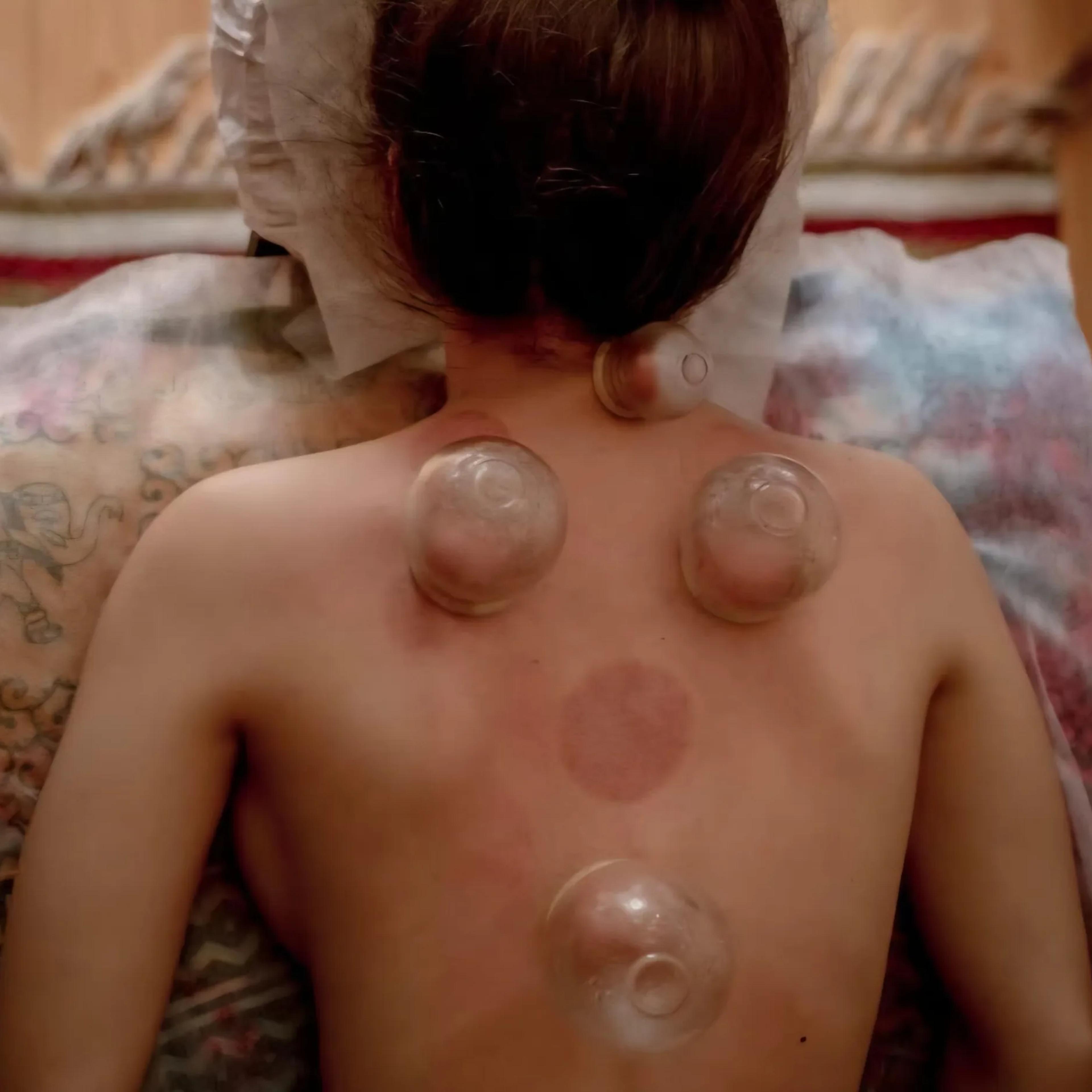 Cupping massage