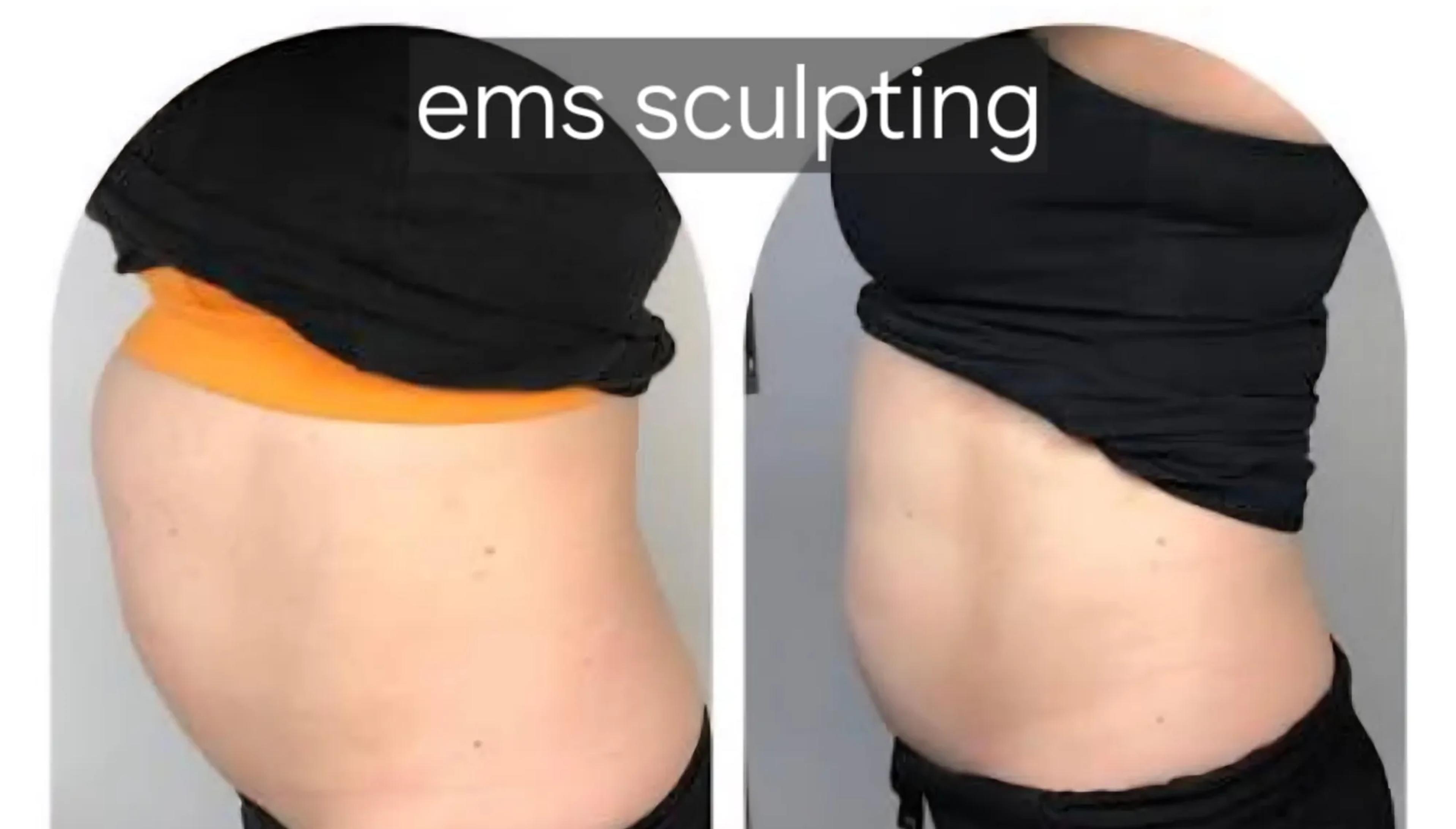 EMS sculpting: voor en na