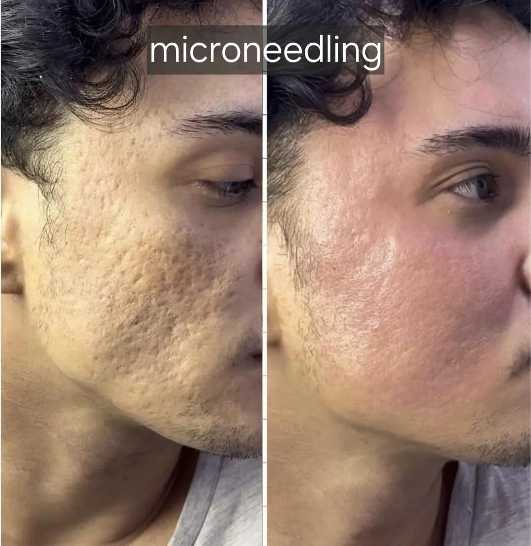 Microneedling