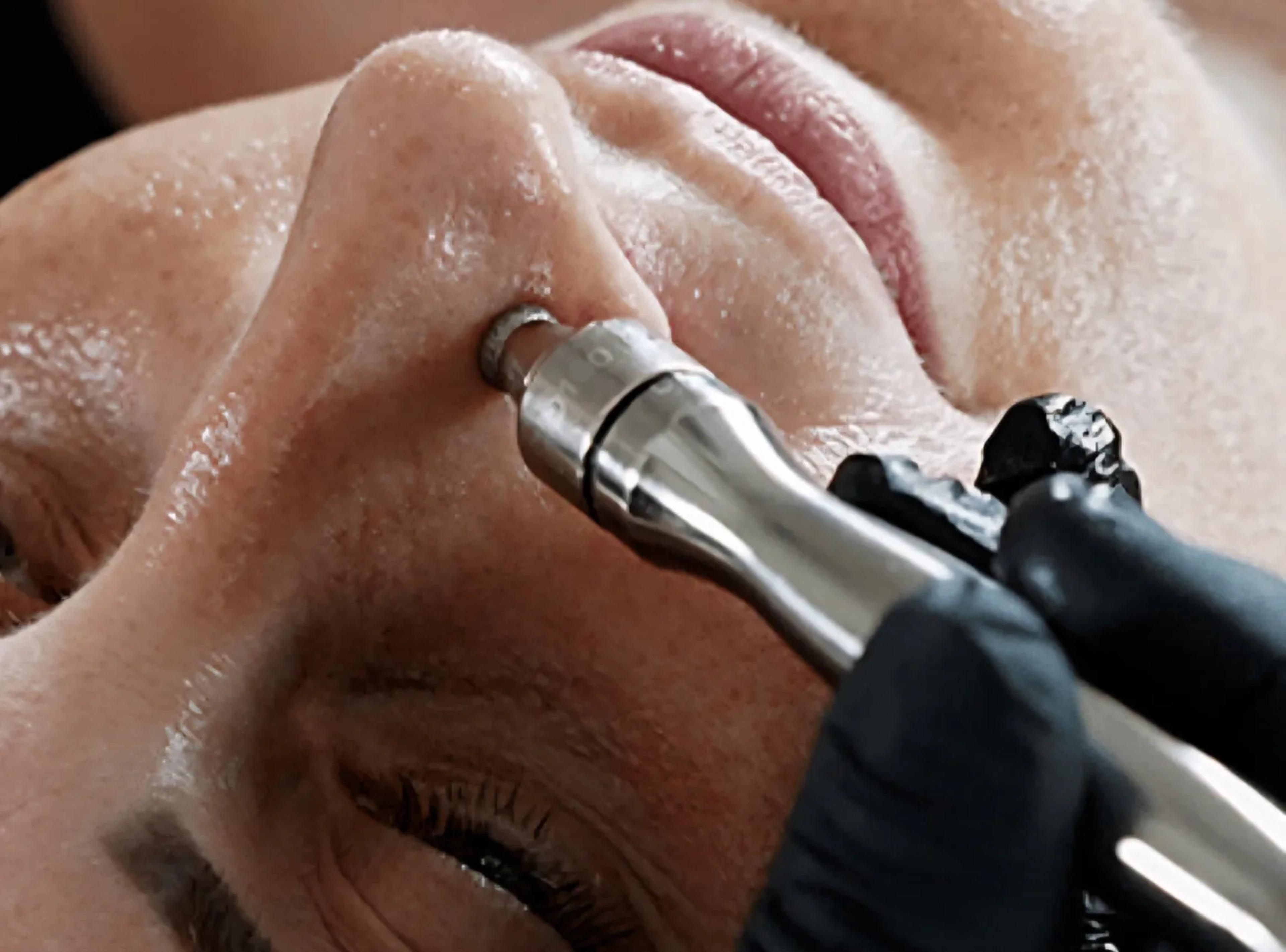 Dermabrasie