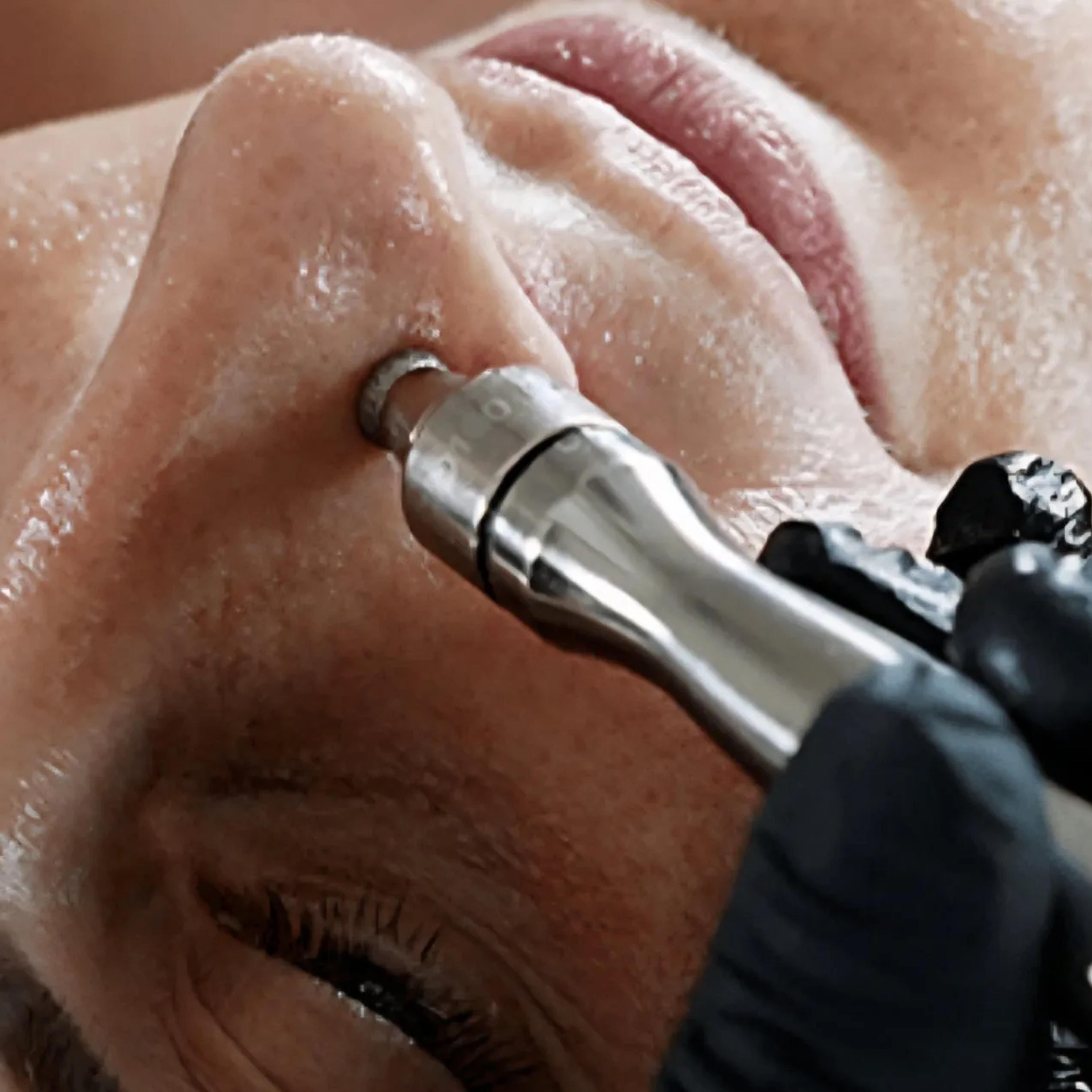Dermabrasie