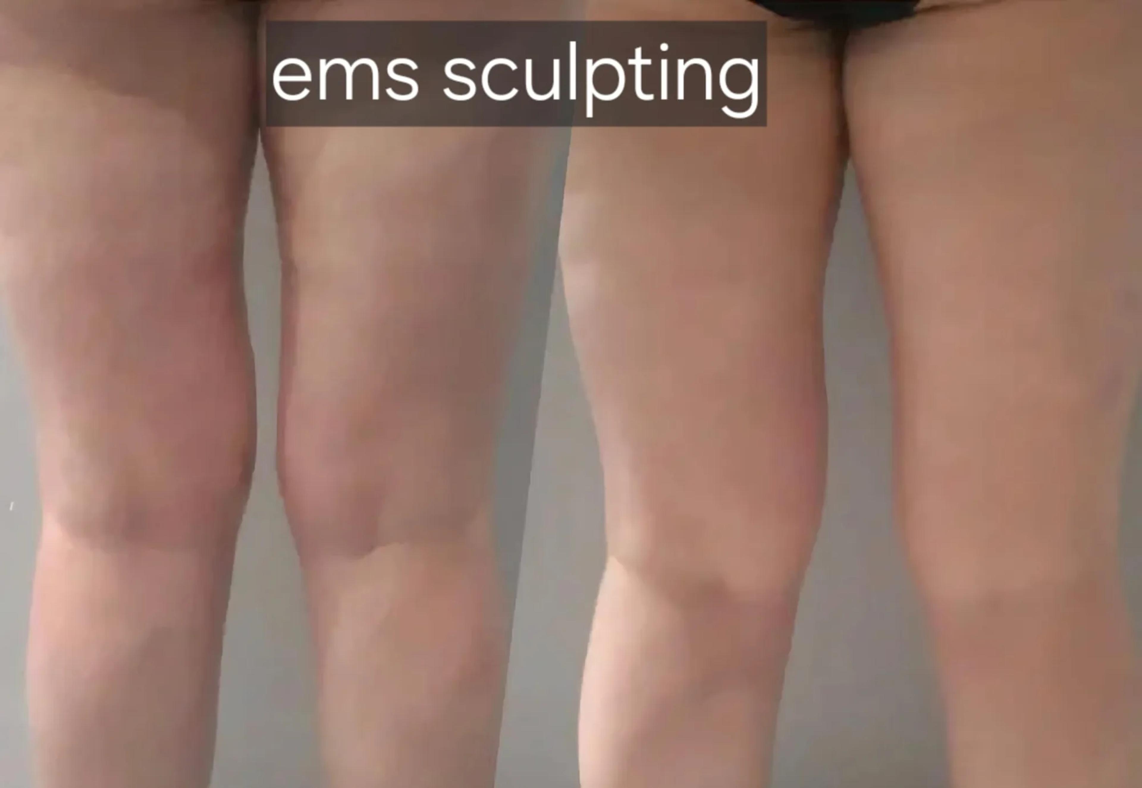 EMS sculpting: voor en na