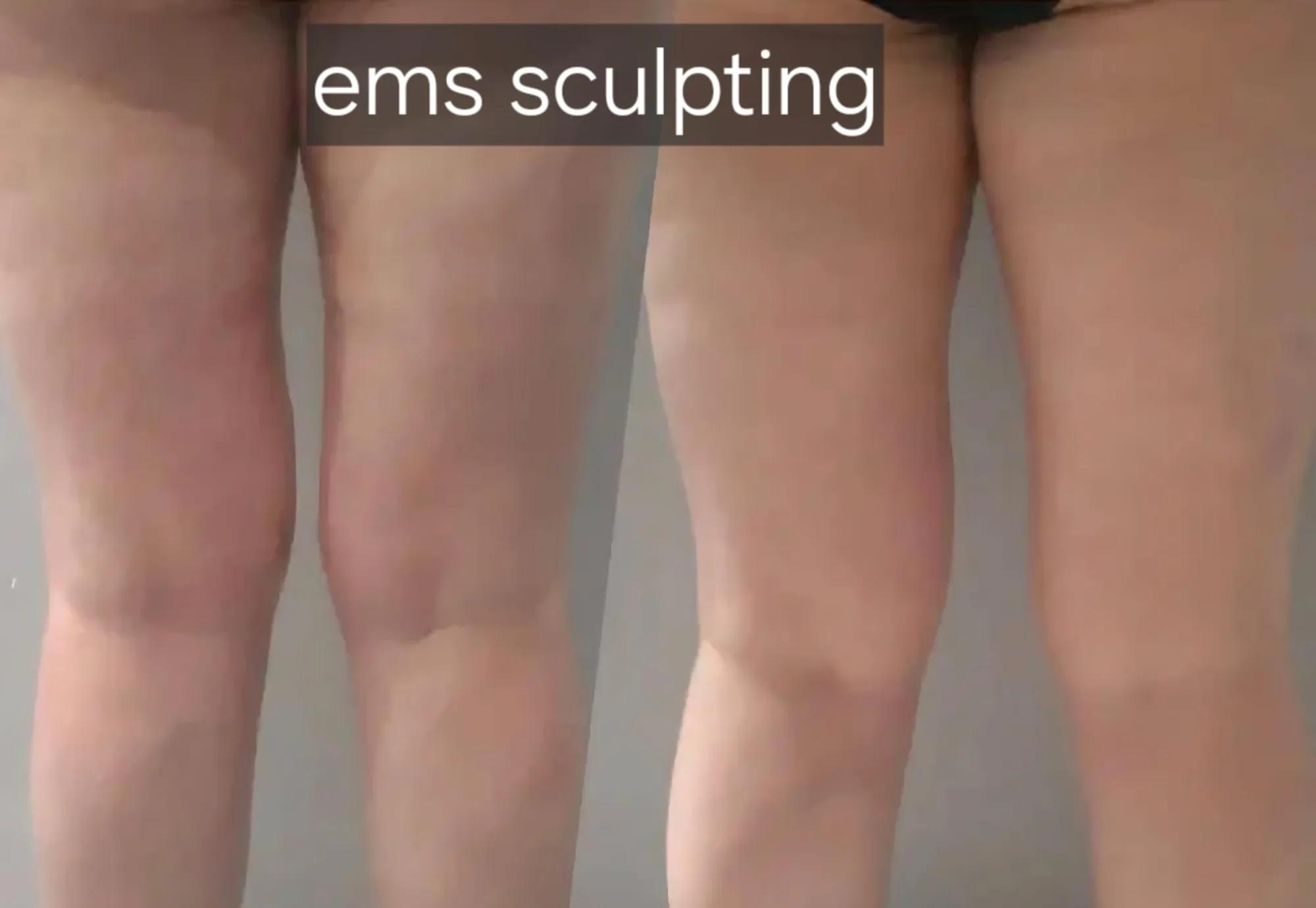 EMS sculpting: voor en na