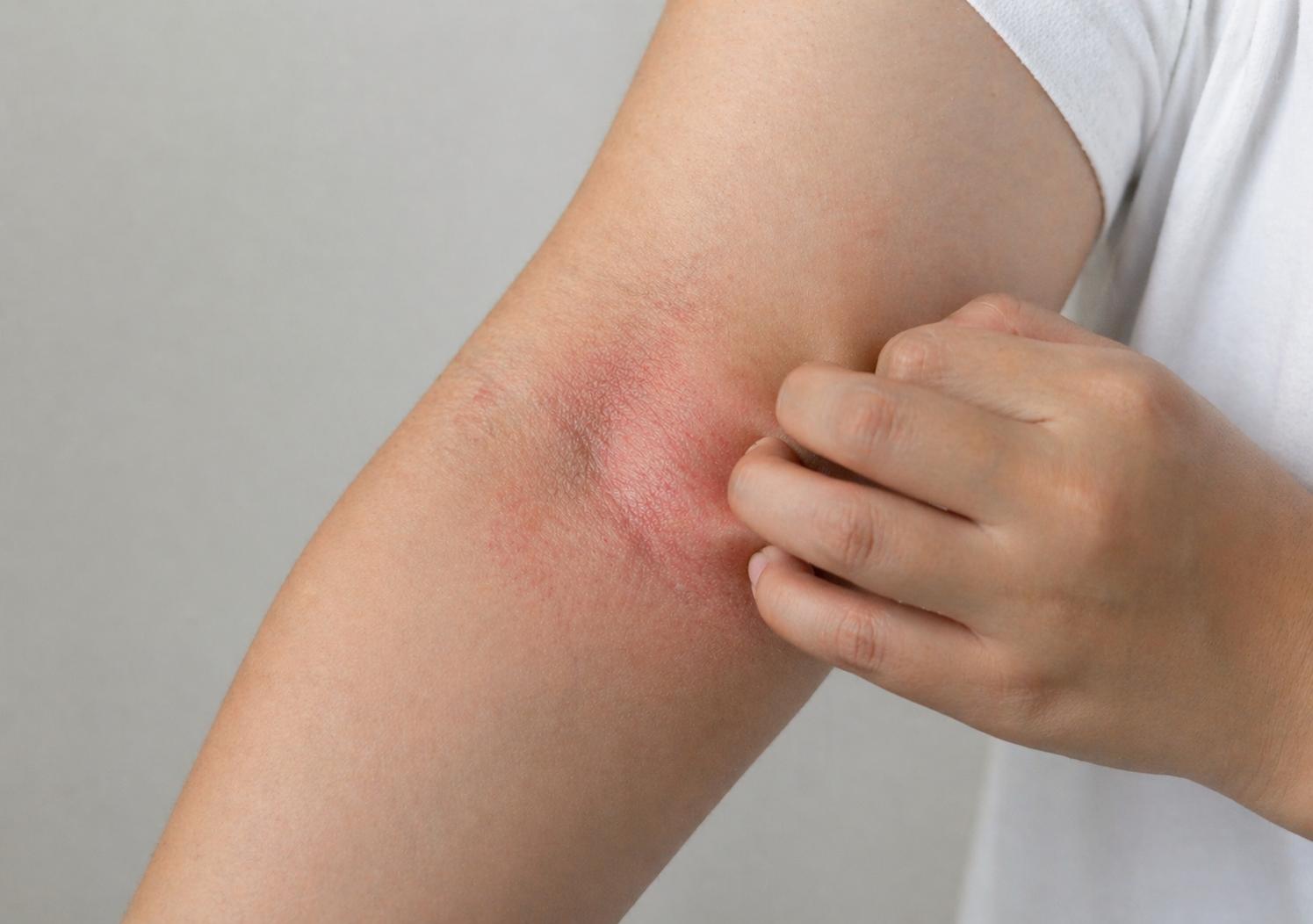 Eczema rash with redness and itching on inner elbow