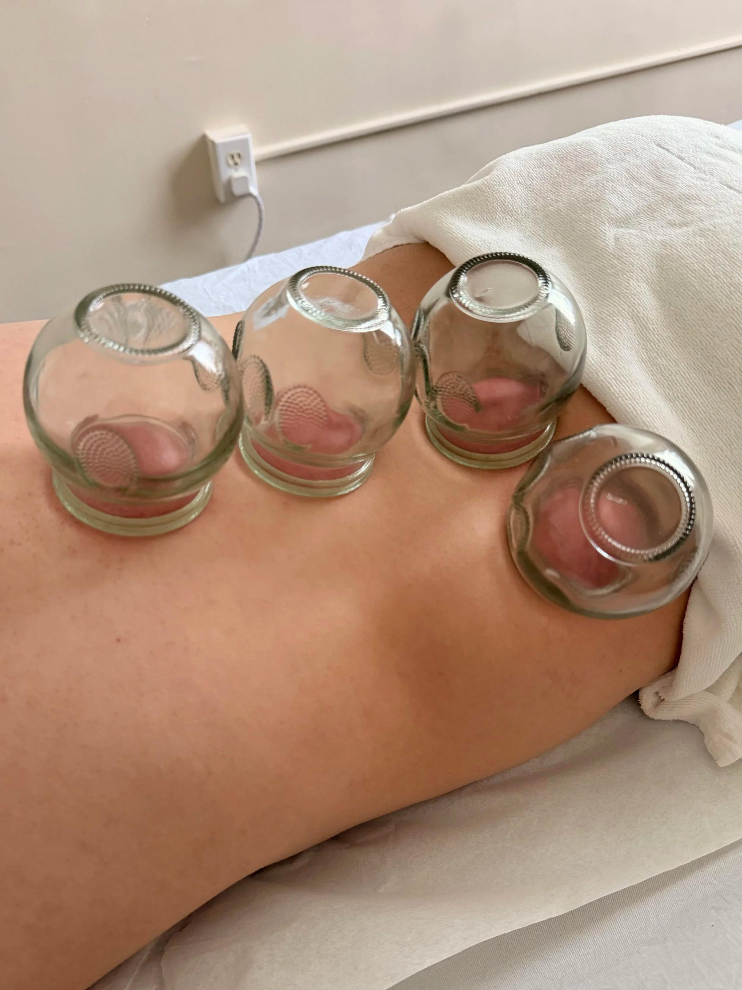 Four glass cupping cups placed on a person’s back during treatment.