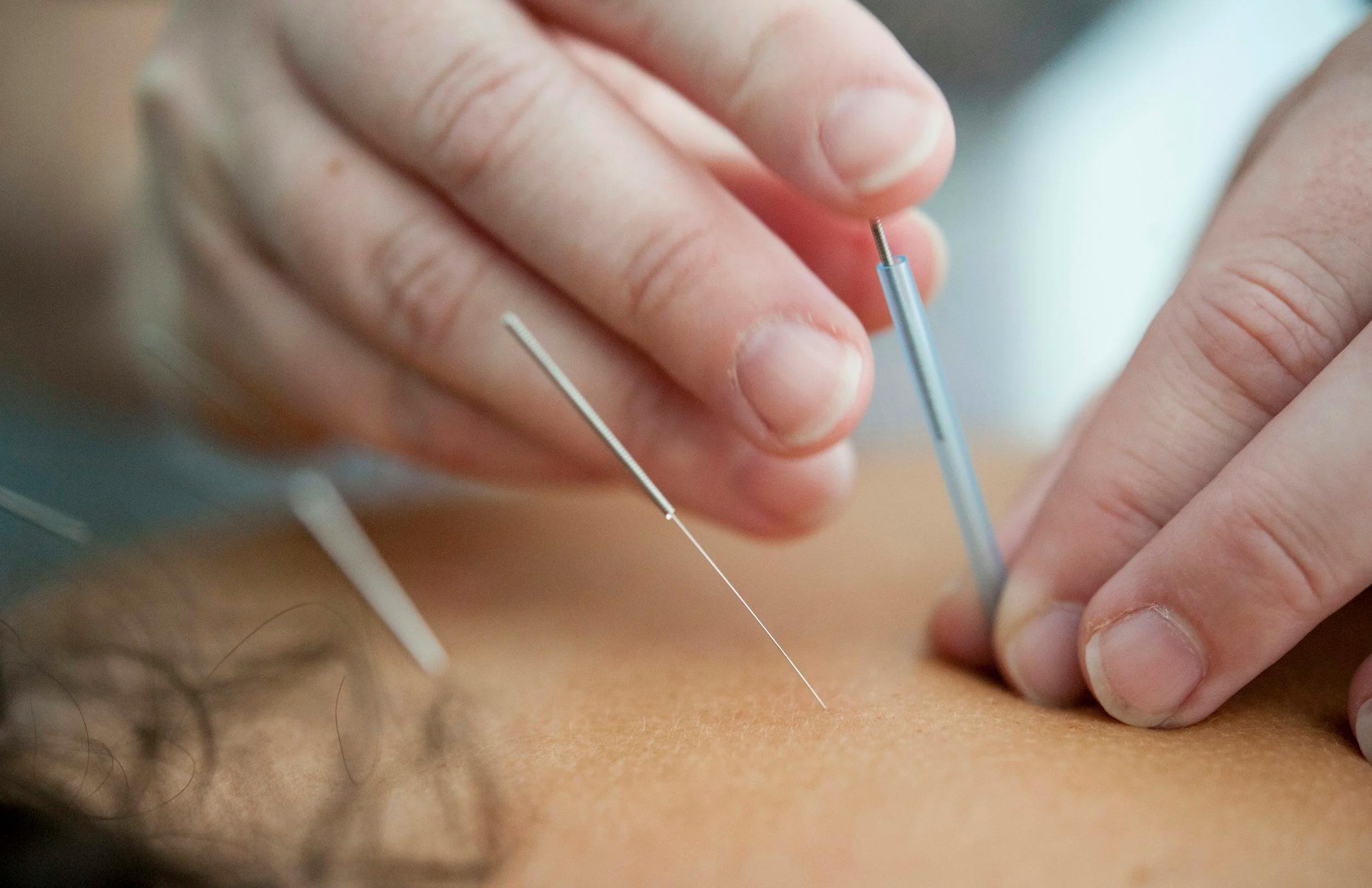 Close-up of acupuncture needles being placed during treatment.