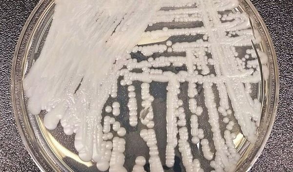 Gljivica "Candida auris", poznata i kao "C. auris", predstavlja vrstu kvasca koji može da izazove teške infekcije kod osoba sa oslabljenim imunitetom