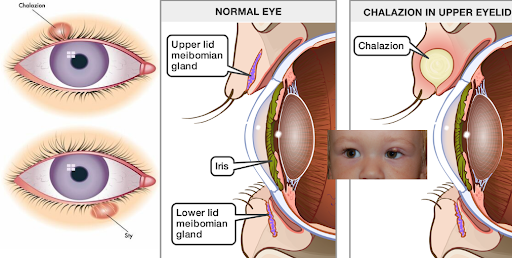 Childhood Chalazion: Symptoms, Causes, and Treatment