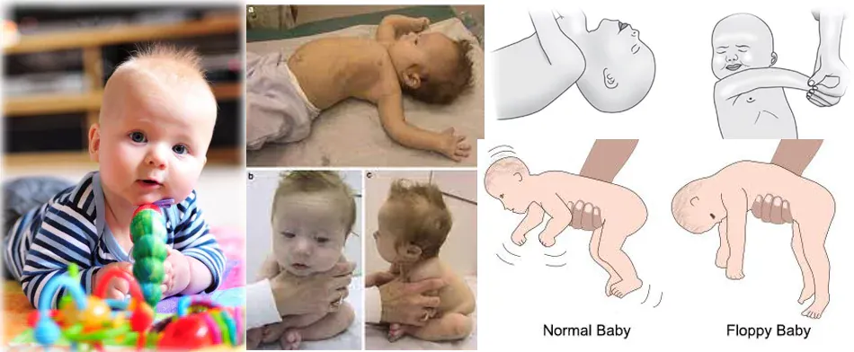 Hypotonia in Infants – Floppy Muscle Syndrome