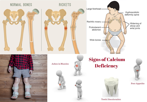 Calcium Deficiency and Rickets in Kids: Causes, Symptoms, and Prevention