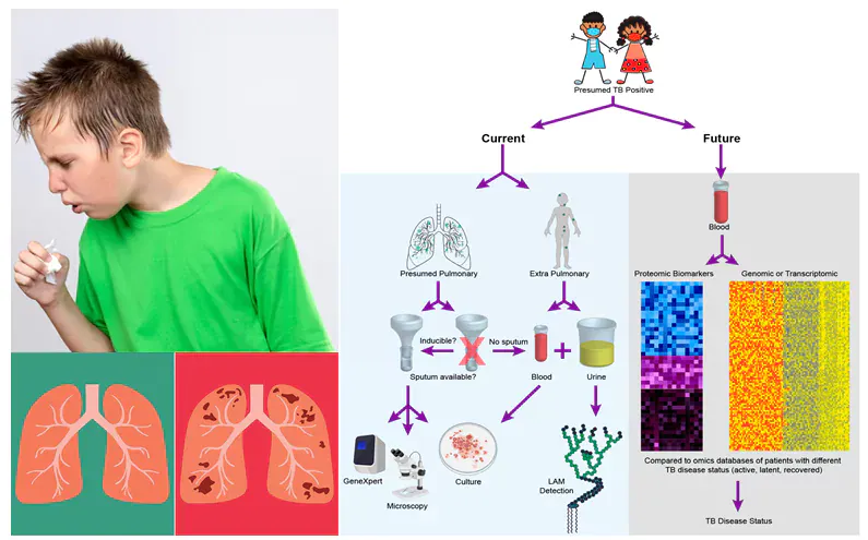 Tuberculosis In Children