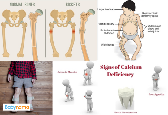 Calcium Deficiency & Rickets In Kids: Causes, Symptoms, & Complications