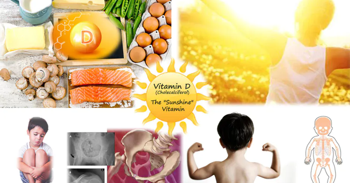 Visual depiction of vitamin D deficiency in children