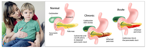 Pediatric Pancreatitis in Children: Causes, Symptoms, and Diet