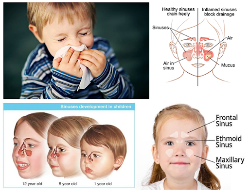 Pediatric Sinusitis: Causes, Symptoms, and Treatment