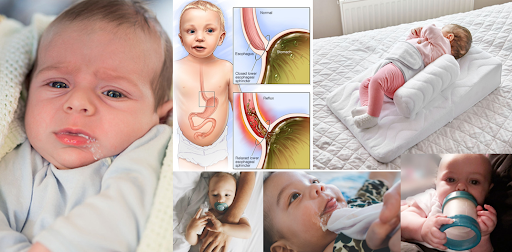 Regurgitation (Reflux) in Babies: Causes, Symptoms, and Management