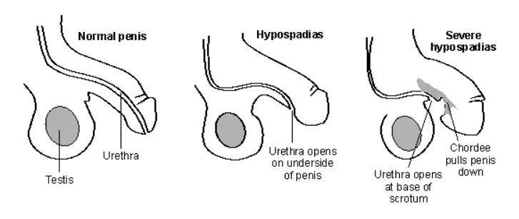 Hypospadias In Infants