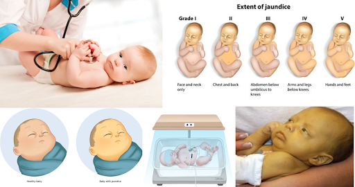 Jaundice in Babies: Types, Symptoms, Causes & Treatment