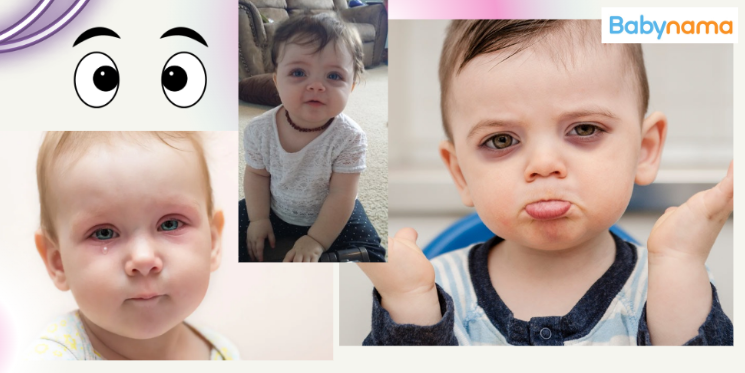 Why Do My Infant's Eyes Have Dark Circles?