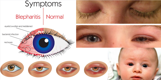 Pediatric Blepharitis: Causes, Symptoms, and Treatment