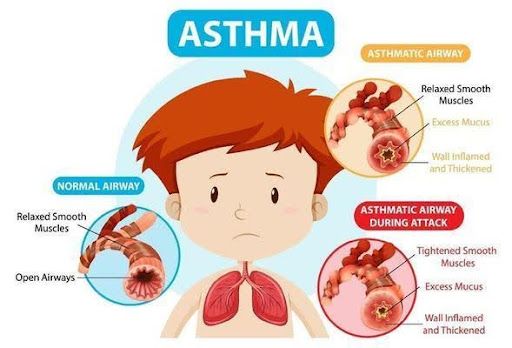 All About Childhood Asthma: Causes, Symptoms, and Management