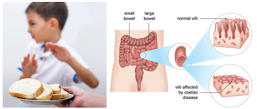 Gluten-Free 101: A Child's Guide to Celiac Disease