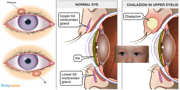 Childhood Chalazion in Babies: Symptoms, Causes, and Treatment