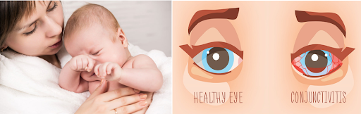  Conjunctivitis (Red Eye) in Children: Causes, Homecare, and Treatment