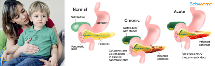 All About Paediatric Pancreatitis In Children