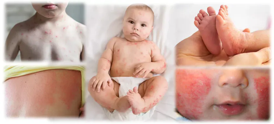 Viral rash in infants – Does my baby have a rash due to a virus?