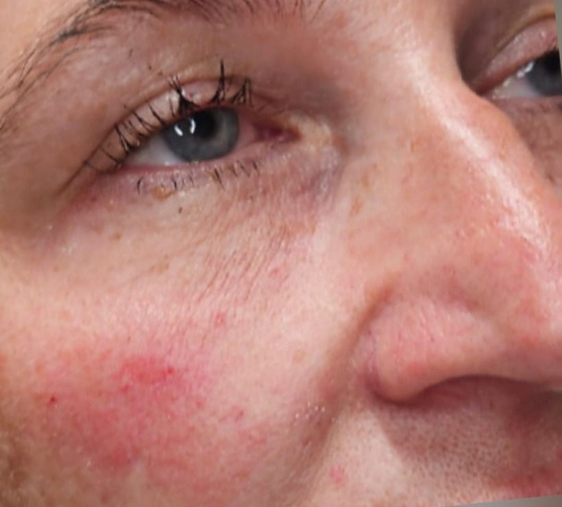 Side angle of client's under-eye area before dermal filler treatment