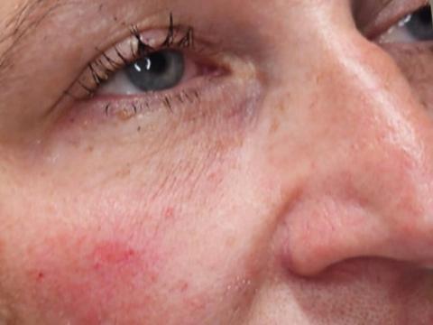 Side angle of client's under-eye area before dermal filler treatment
