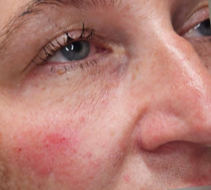 Side angle of client's under-eye area before dermal filler treatment