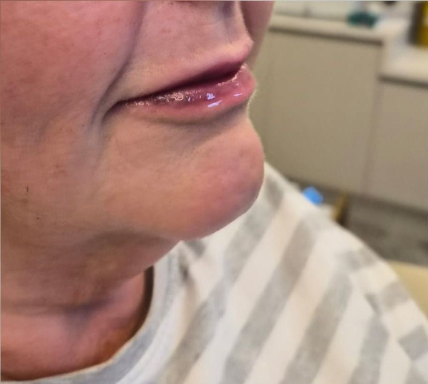 Front view of client's lips and chin before dermal filler treatment