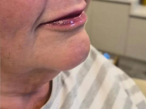 Front view of client's lips and chin before dermal filler treatment